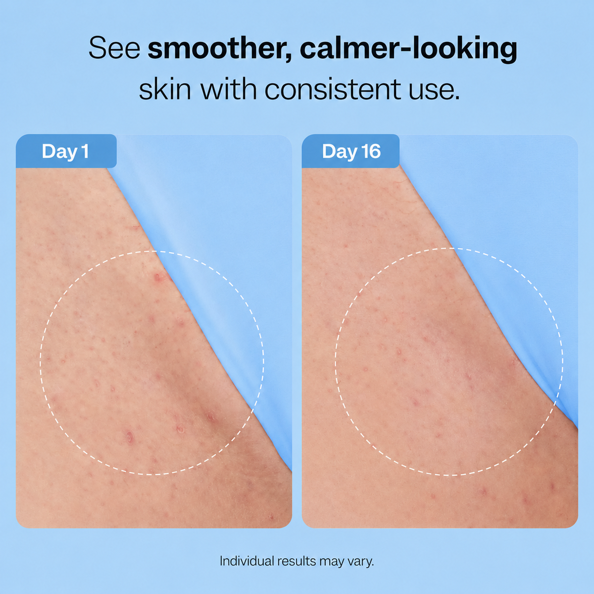 Ingrown Hair Smoothing Solution