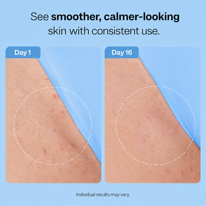 Ingrown Hair Smoothing Solution