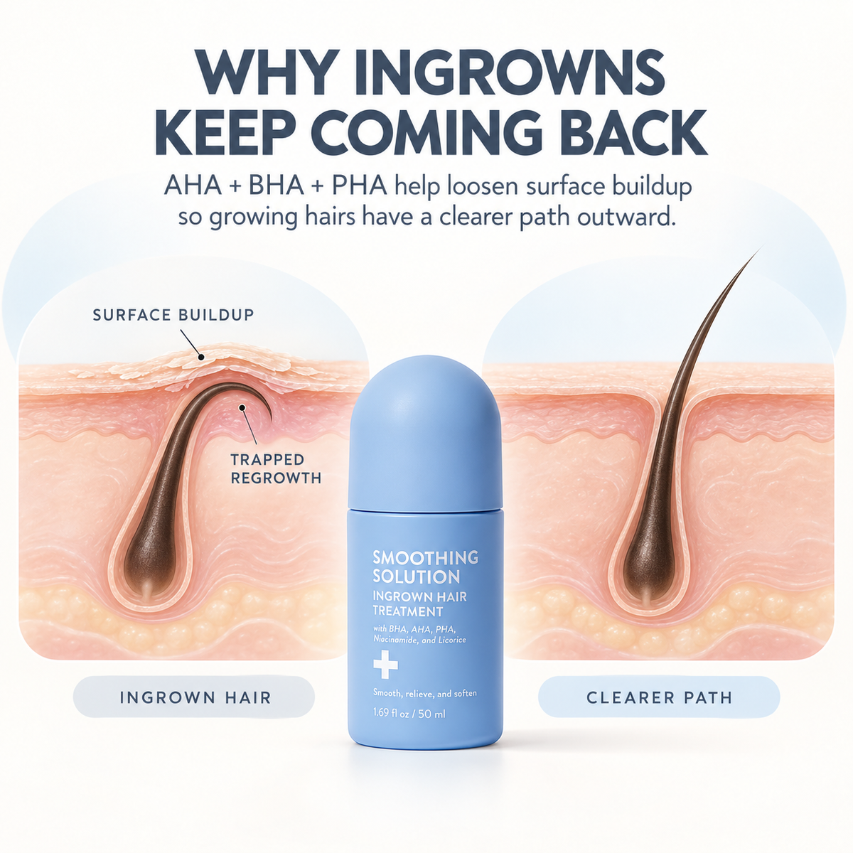 Ingrown Hair Smoothing Solution